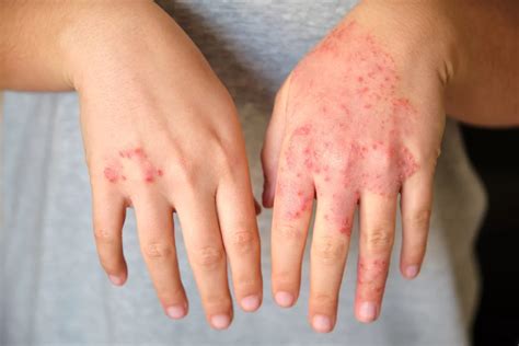Round Eczema On Hands