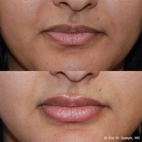 Eric M. Joseph, MD | Lip Augmentation Before and After Photos