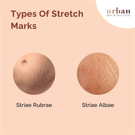 Stretch Marks Types, Causes, Symptoms & Treatment |USHC