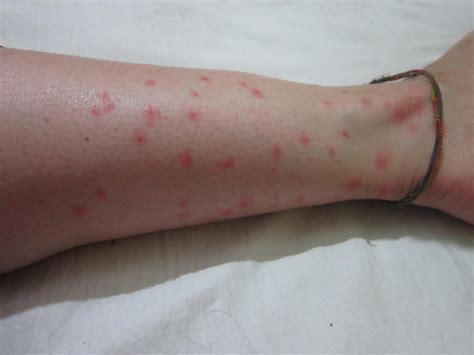 Biggest Bug Bite
