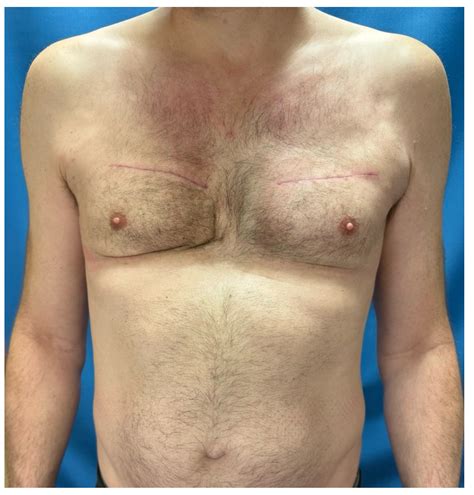 Long-Term Complications of Aquafilling Injection after Male Breast Augmentation: A Case Report
