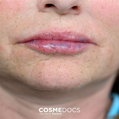 Bad Lip Fillers Are Not Bad Luck : Let's Undo The Unnecessary