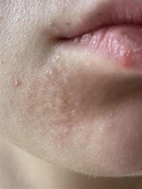 Bumps on chin (sebaceous hyperplasia?) – Acne – Acne.org Forum