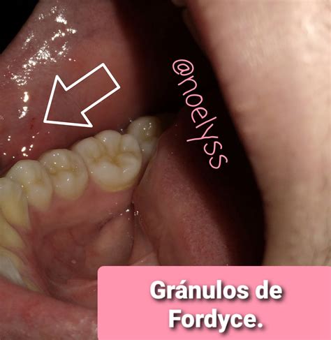 🤔 Fordyce granules and how can they be confused with pathologies? | Gránulos de Fordyce y ¿Como ...