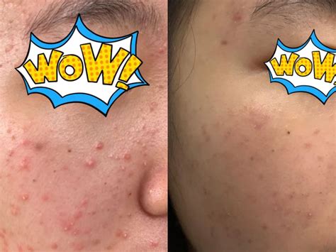 Tinea Versicolor Shampoo at Marianne Pryor blog