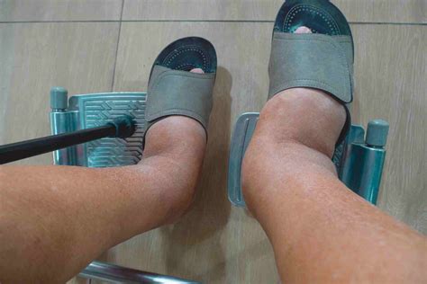 What Causes Heat Edema and When Should You See a Doctor?Texas Vascular ...