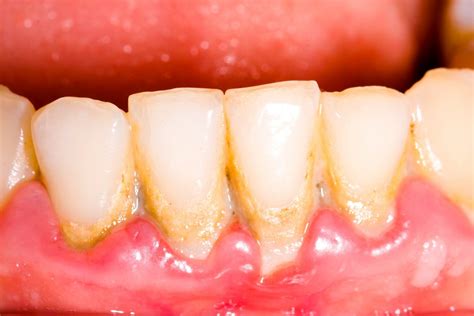 Receding Gums: Its Causes and Treatment | OraMD
