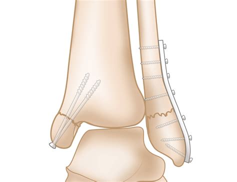 Lateral Malleolus Anatomy