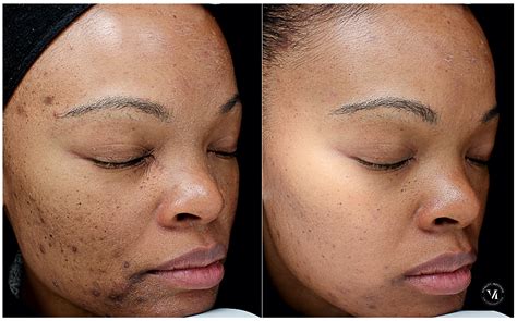 Chemical Peel For Dark Spots