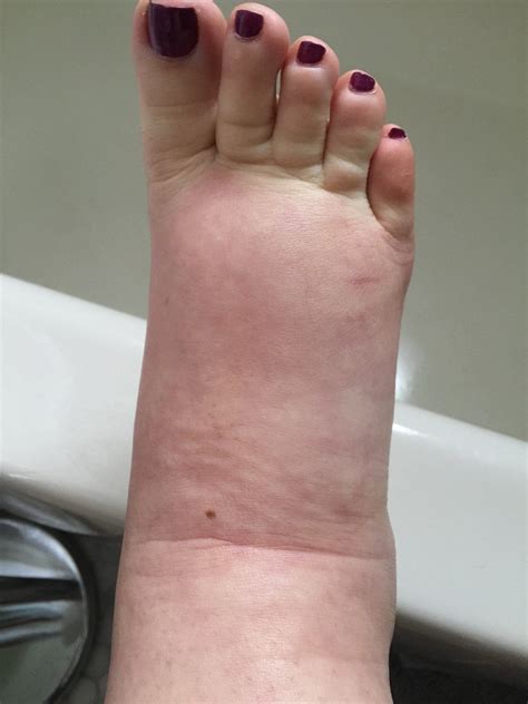 How to Manage Massive Pregnancy Swelling — First Thyme Mom | Pregnancy ...