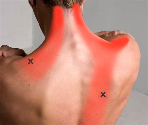 Trapezius Muscle Injury at John Mccloud blog