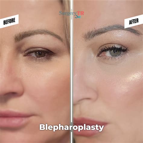 Blake Lively: Eyelid and Nose Job Surgery | SurgeryTR
