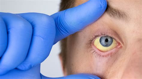 Yellow Eyes Jaundice