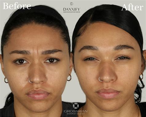 Daxxify Before & After Photos | Grossman Dermatology