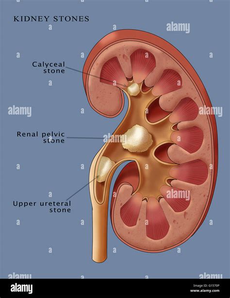 Staghorn Kidney Stones