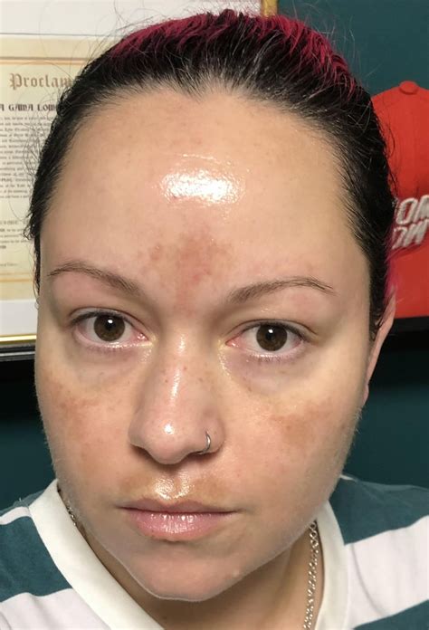 [Before&After] [Selfie] I have been using 20% Azelaic acid for a month ...