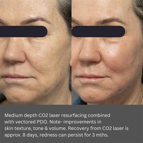 Best CO2 Laser Resurfacing Near Me | Dr Davin Lim