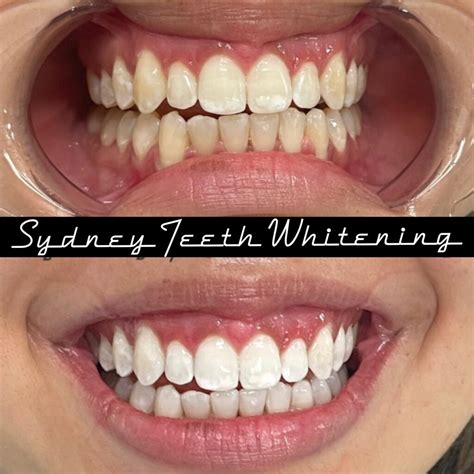 Teeth Whitening Strips Leave Teeth Patchy at Charlotte Hudson blog