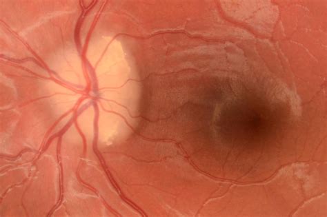 Optic disc drusen and pseudo-papilloedema