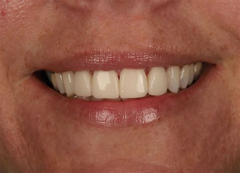 Gum Abscess Popped? Thinking of Popping It Yourself?