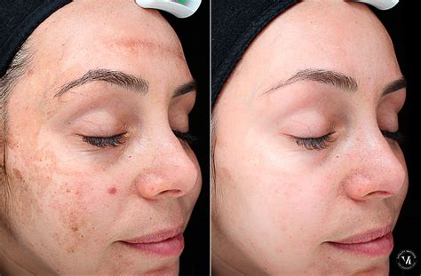 Chemical Peels Before and After Photos in Houston, TX, Patient 10795 - Mirror Mirror Beauty Boutique