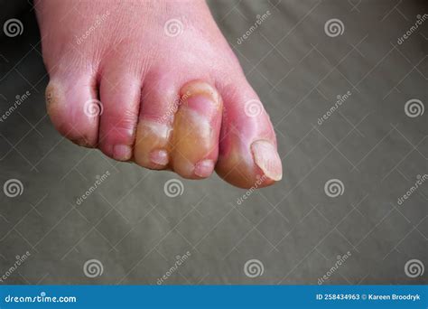 Close Up of Water Blisters on the Toes of Paraplegic after Serious Hot ...