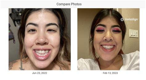 33 week progress : r/Invisalign