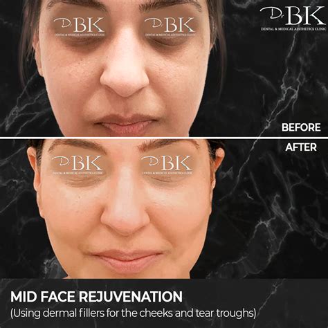 Non-Surgical Dermal Filler Cheek Sculpting | DrBK Clinics