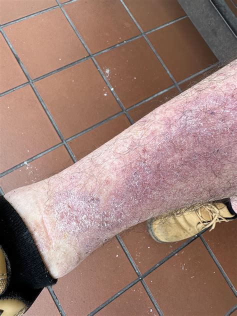 Aftermath of a bat bite : r/rabies