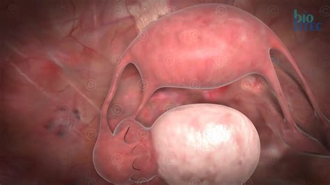 Animation gynecological surgery - MedicalGraphics