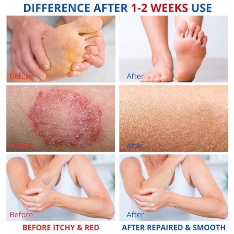 Antifungal Cream for Athletes Foot, Jock Itch, Bermuda | Ubuy