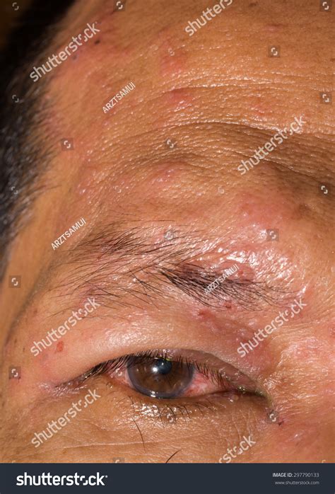 Close Herpes Zoster Ophthalmicus During Eye Stock fotografie 297790133 ...