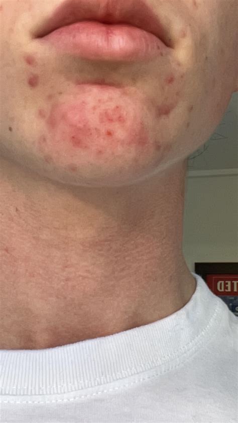 I only get acne around my chin, i’ve tried different products and i have a skin care routine ...