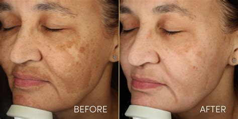 Top Pigmentation Treatments & Scientific Advances of 2024 - Dr Nerina Wilkinson + Associates