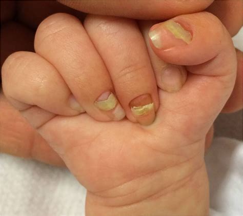 Onychomadesis In Toddlers Possible Relation Of Skin And Nail Changes