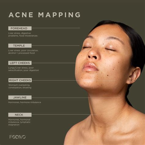 Acne Mapping | Acne mapping, Face mapping acne, Forehead acne