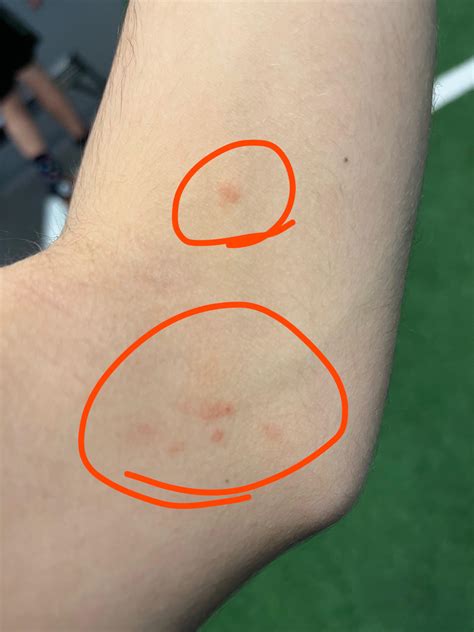 Why Are There Weird Bumps On My Elbow at Maria Baum blog