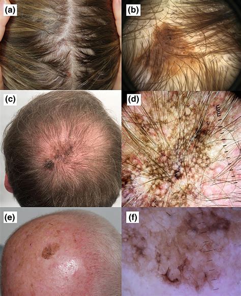 Melanoma On Scalp