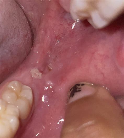 Hole in back of my gums/canker sore?? 2 yrs ago my dentist told me a ...