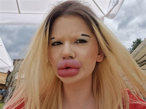 Woman with ‘world’s biggest lips’ gets UMBILICAL CORD CELLS injected ...