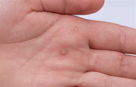 Answers to Frequently Asked Questions About Warts - Health Tenfold