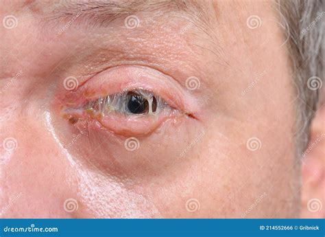An Eye with Bacterial Purulence Conjunctivitis, Also Known As Pink Eye Stock Photo - Image of ...