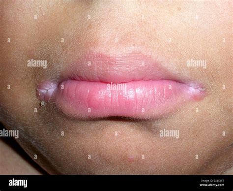 Angular cheilitis, also known as angular stomatitis, is an inflammatory lesion at the labial ...