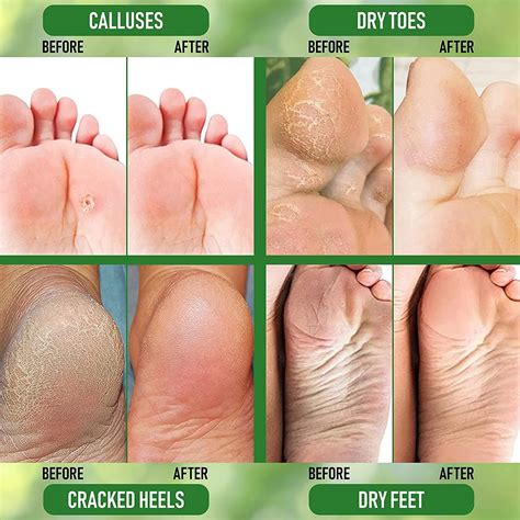 PurOrganica Urea 40% Foot Cream - Callus Remover for Thick, Cracked ...