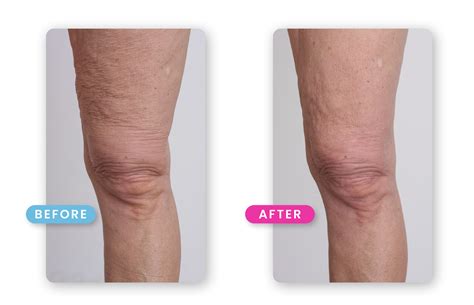 How to Get Rid of Loose Skin on Legs - 7 Surefire Techniques That Work