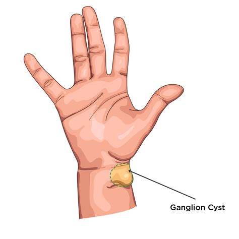 Hand & Wrist Surgery in Leeds - Skin Surgery Clinic