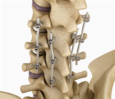 Spinal Fusion – Cedar Park, TX – Austin, TX - Spine Stabilization