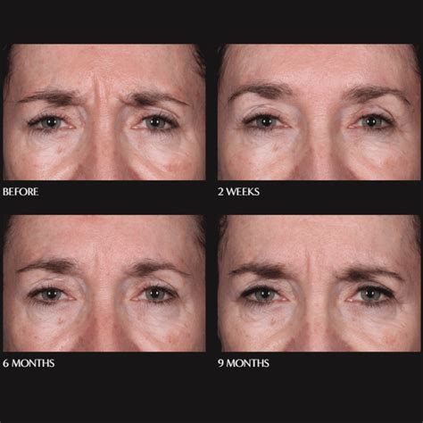 Daxxify® - New Medical Spa