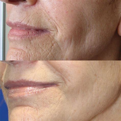 Microneedling Before and After Wrinkles - See the Difference!