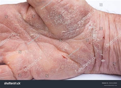 Hand Eczema Lesions Hemorrhages Cracks Crusts Stock Photo 2505218969 ...